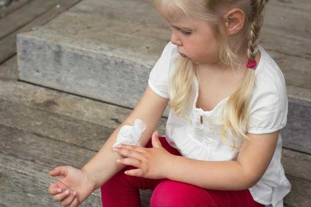 Как провести лечение крапивницы у ребенка дома?
